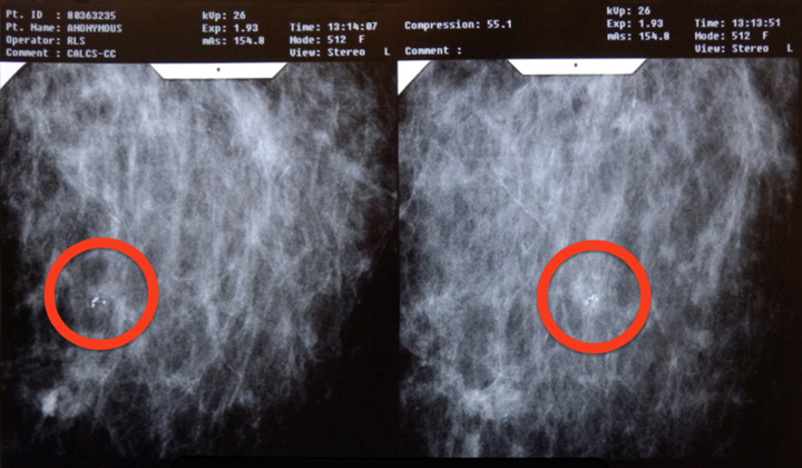 Stereotactic Breast Biopsy