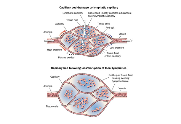 Lymphedema: What, When, How?