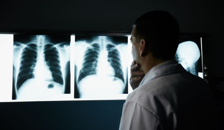 The Effects of Post-Lumpectomy Radiation Therapy on Lung Cancer Risk