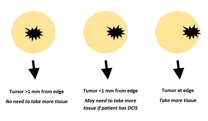 Breast Cancer Lumpectomy Margins
