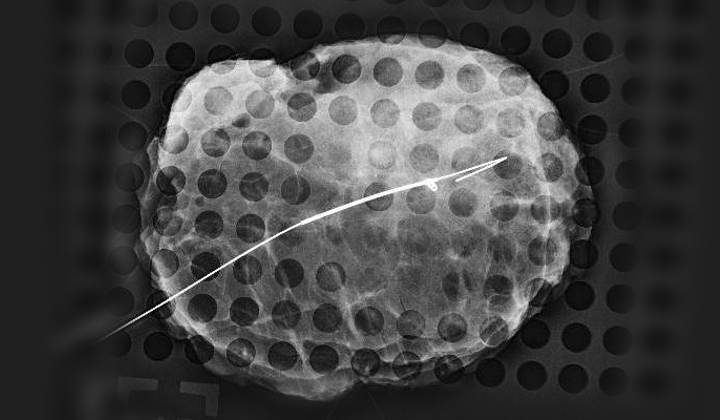 Localized Excisional Biopsy and Lumpectomy