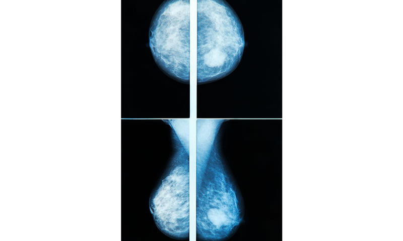 Change in Mammographic Density as a Marker of Tamoxifen Effect in Premenopausal Breast Cancer