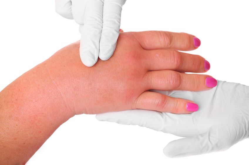 Screening for Lymphedema