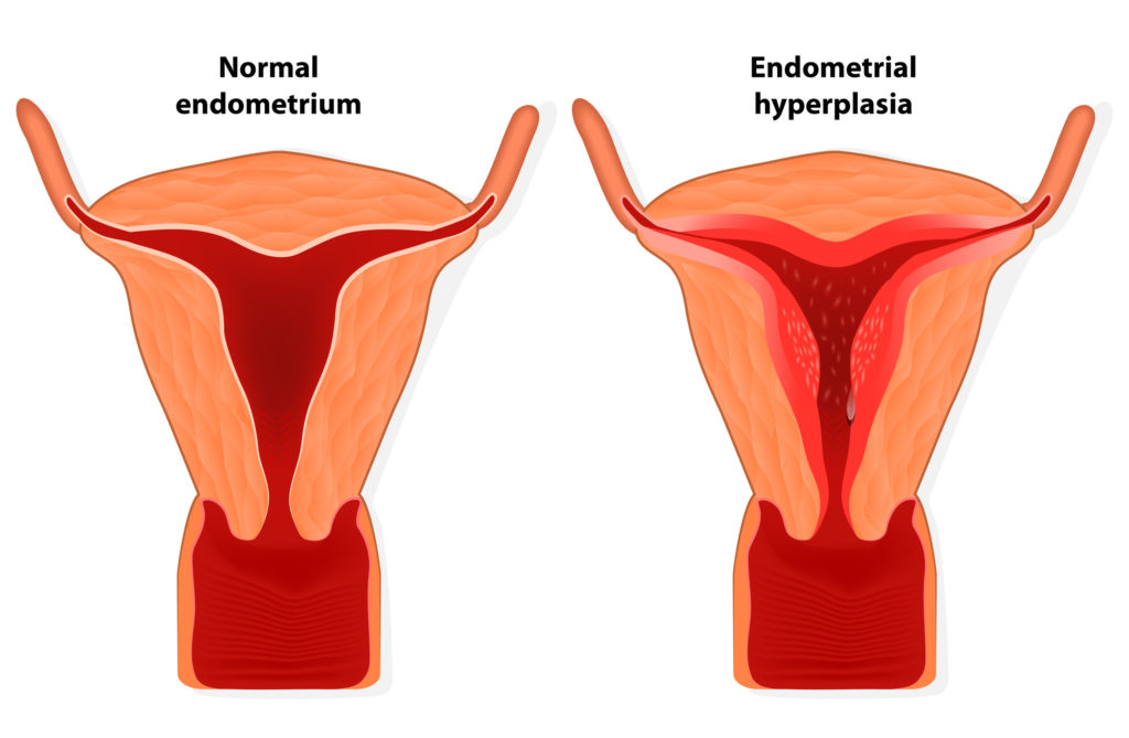 Use of Metformin to Combat Tamoxifen-Related Endometrial Changes