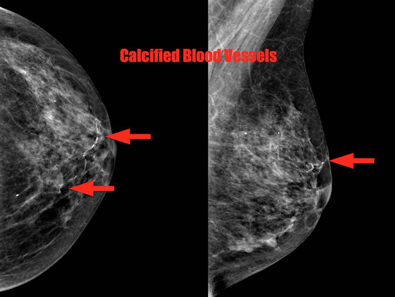 vascular breast calcifications Vascular breast calcifications