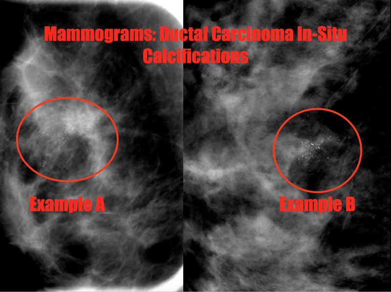 Ductal Carcinoma In Situ Dcis On Breast Imaging The American Society Of