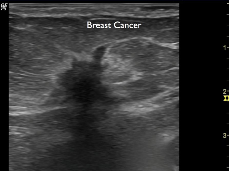 Beneath the Surface: A Guide to Breast Imaging – Breast360.org  The American Society of Breast 